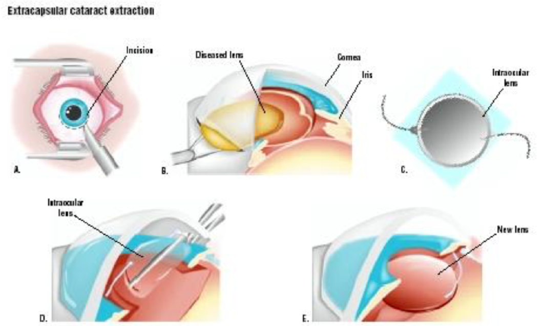 What is cataract surgery